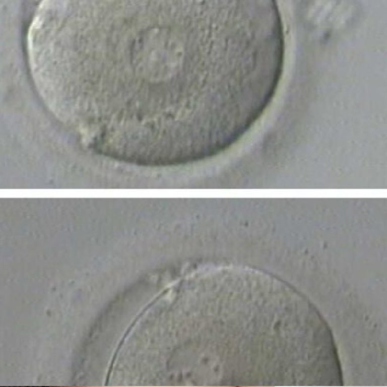 azospermi-ve-fsh-i-lis-kisi_1692010060